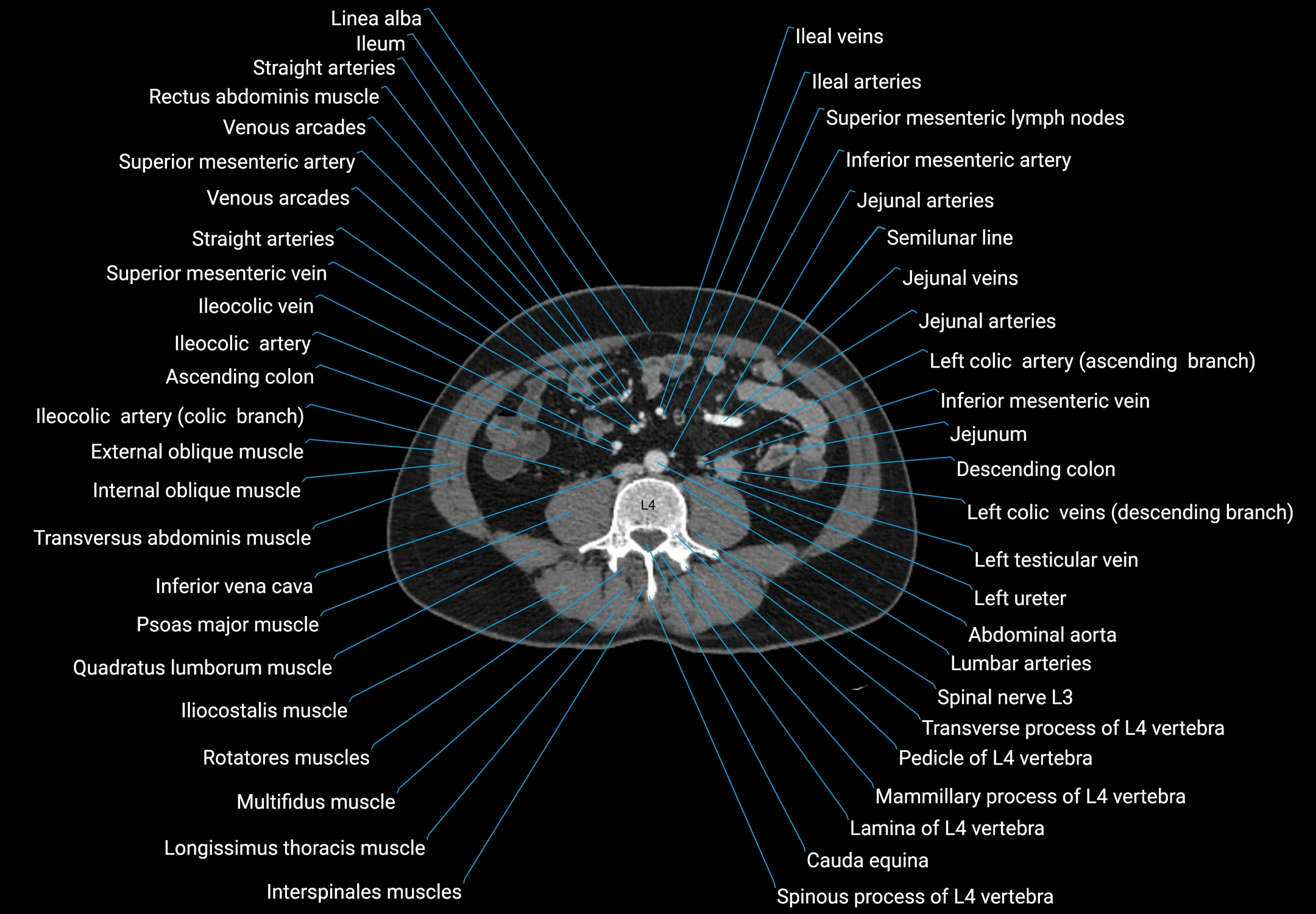 CT male pelvis axial cross sectional anatomy labelled radiology image -00106.webp